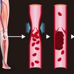 Trombose Venosa Profunda representa um risco grave à saúde vascular